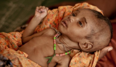 दुर्गमका बालबालिकामा कुपोषणको समस्या