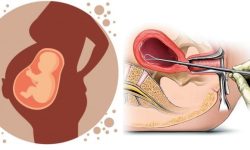 नेपालमा सुरक्षित गर्भपतन : कानुन छ, सहज पहुँच छैन