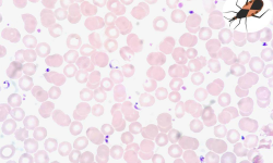 अमेरिकन ट्रिपानोसोमियासिस : जसले प्रत्येक वर्ष १२ हजार मानिसको ज्यान लिन्छ