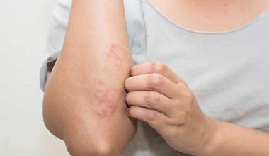 बाजुराका एक बालकमा कालाजार भेटियो