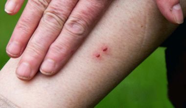 अस्पताल पुर्‍याए बाँच्छन् सर्पदंशका बिरामी