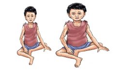 कुपोषित बालबालिकाको सङ्ख्या बढ्दै