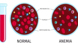 सिकल सेल एनीमिया !