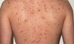 गोकर्णेश्वरमा देखिएको दादुरा नियन्त्रणमा