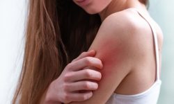 वर्षामा छालाकाे एलर्जी हुन नदिन के गर्ने ?