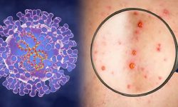 यस्ता हुन्छन् मङ्कीपक्सका लक्षण, रोकथामका लागि के गर्ने ?