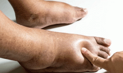 के हो एडेमा रोग ?