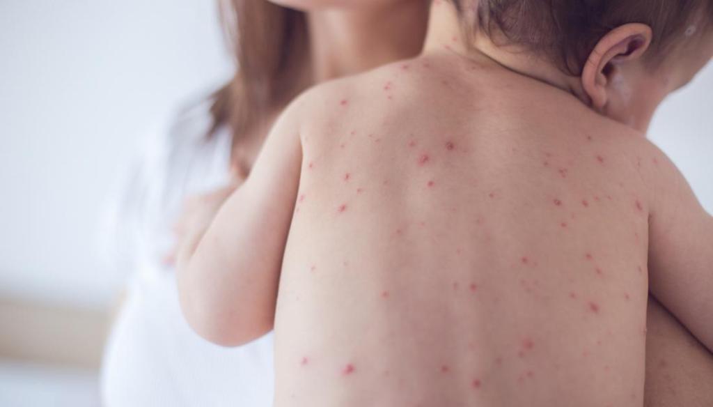 १६ जिल्लाका एक हजारभन्दा बढी दादुराबाट संक्रमित