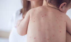 दादुराबाट १६ जिल्लाका एक हजारभन्दा बढी सङ्क्रमित