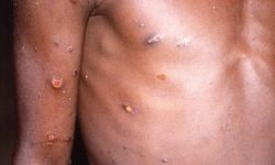 थप एक नेपालीमा मङ्किपक्स पुष्टि