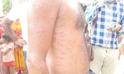 वीरगन्जमा देखियो एकै घरका पाँच जनासम्म ठेउला रोग