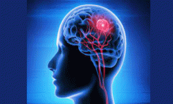 ब्रेन ट्यूमरका लक्षण र उपचार