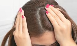 चायाको समस्या छ ? अपनाउनुस् यी घरेलु उपाय