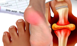 यूरिक एसिड बढ्दा खान नहुने खाना !