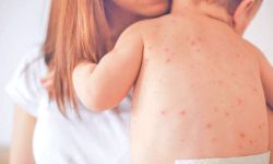 सुडानी शिविरमा दादुराको कारण १३ बालबालिकाको मृत्यु