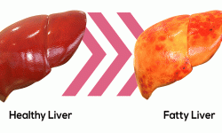 नन् अल्कोहोलिक फ्याटी लिभरको समस्या !