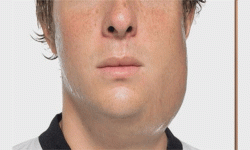 हाँडे वा गलफुलोको प्रकोप