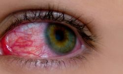 आँखा पाक्ने ‘भाइरल फ्लु’ फैलिएपछि अस्पतालमा भीड