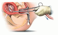 गर्भपतनका लागि अझै कठोर छ संसार