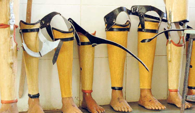 कृतिम खुुट्टा जडान सुरु