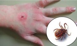 स्याङ्जामा स्क्रब टाइफस देखियो, विद्यालय बन्द