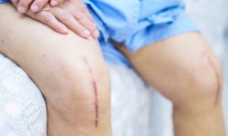 घुँडाको निःशुल्क प्रत्यारोपण