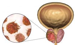 पुरुषमा प्रोस्टेट क्यान्सर