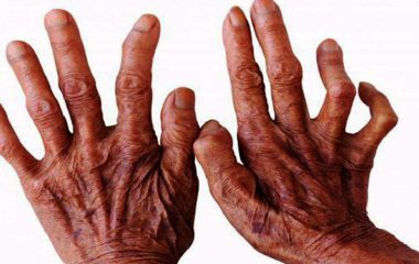 जाजरकोटमा १८ जना कुष्ठरोगी उपचाररत