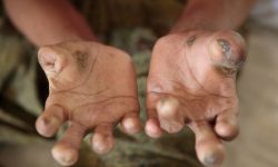 कुष्ठरोगबाट बालबालिका बढी प्रभावित हुँदै