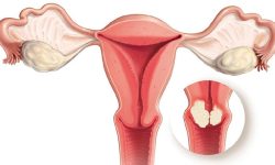 पाठेघर र स्तन क्यान्सर पहिचान गर्न वडामै ‘स्क्रिनिङ’