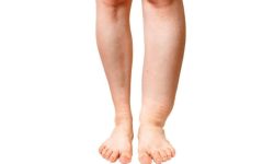 आइतबारदेखि हात्तीपाइले रोगविरुद्ध औषधि खुवाइने