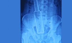 उपचारका लागि आएका पुरुषको मलद्वारमा बोतल अड्किएको देखिएपछि…