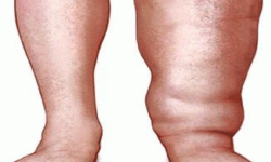 लामखुट्टेमा हात्तीपाइलेको सङ्क्रमण पत्ता लगाउन अनुसन्धान