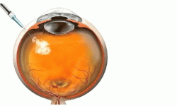 मधुमेहपीडितमा डायबेटिक रेटिनोपेथीको जोखिम