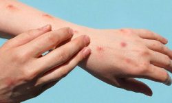 मङ्कीपक्स सङ्क्रमितको स्वास्थ्य सुधारोन्मुख