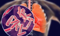 कालीकोटमा नि:शुल्क क्षयरोग परीक्षण शिविर