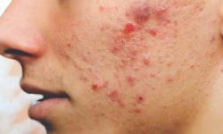 डण्डीफोर हटाउने यी हुन् उपाय