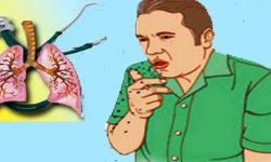 झापामा ६१६ नयाँ क्षयरोगी