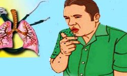 चितवनका सहरी क्षेत्रमा क्षयरोगी बढे