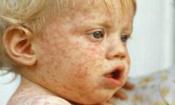 अमेरिकामा दादुराबाट अर्को बच्चाको मृत्यु, करिब ६५० बिरामी : अधिकारीहरू