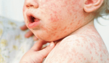 विश्व स्वास्थ्य संगठनले भन्याे- नेपालमा प्राणघातक रोग रुबेला उन्मूलन